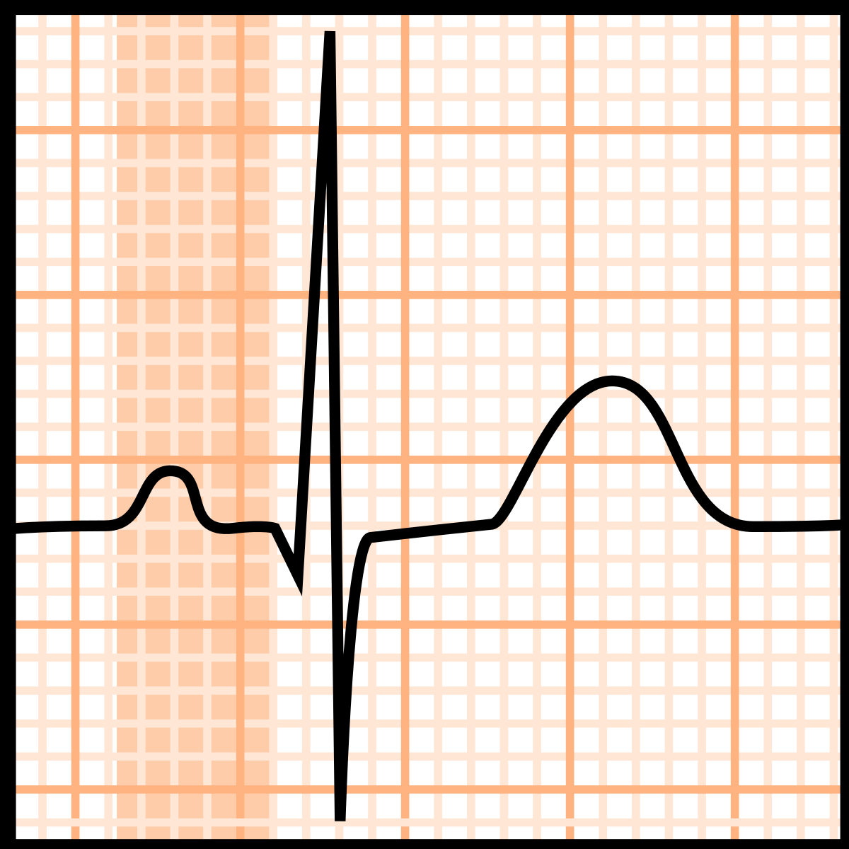 Pr interval cardioschool